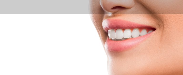 Teeth-Whitening-Dubai