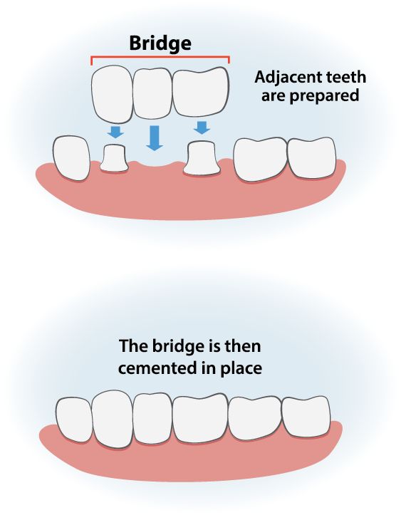 Dental-Bridge-Cost-in-UAE