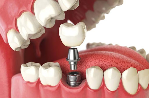 Dental-Implant-in-Dubai