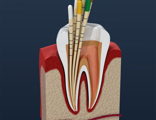 Gutta,Percha,Endodontics,Instrument,,Dental,Anatomy.,3d,Illustration