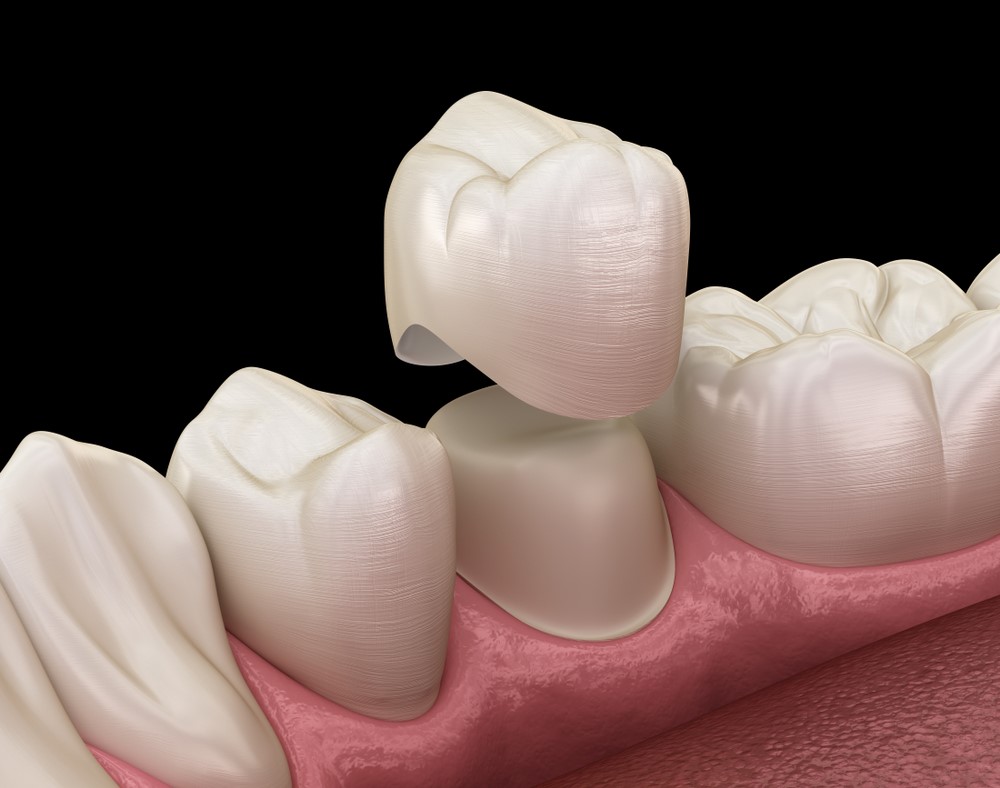 guide-to-dental-crowns