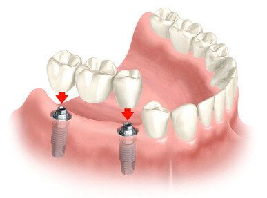 multiple-teeth-implants