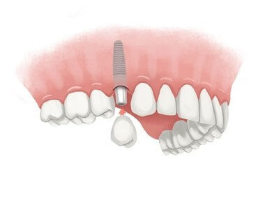 single-dental-Implant
